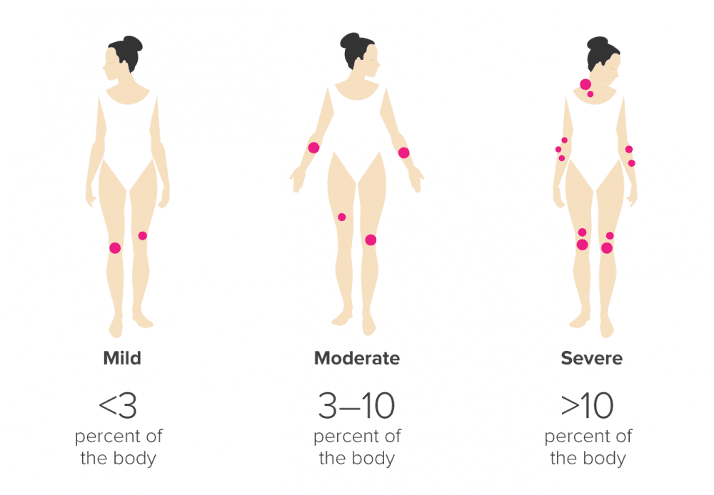 Psoriasis Diagram | Pine Belt Dermatology