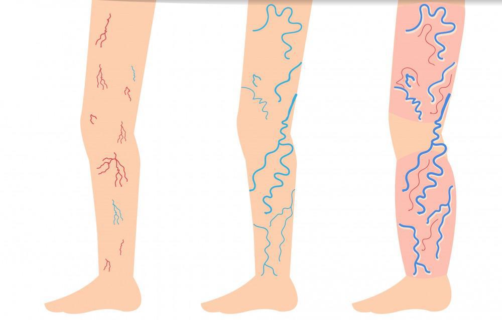 Say Goodbye to Spider Veins | Pine Belt Dermatology