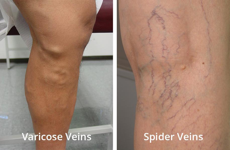 Spider/ Varicose Veins | How to Treat Them | Pine Belt Dermatology