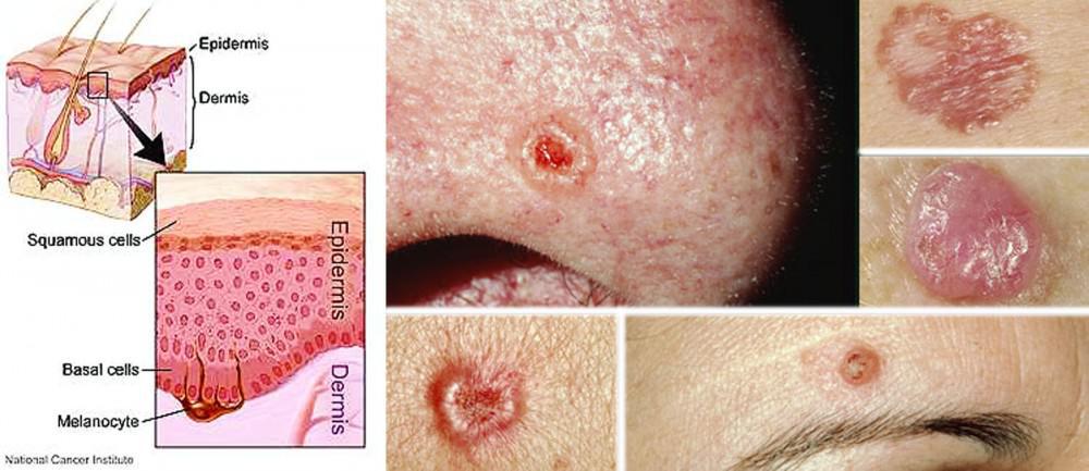 Basal Cell Carcinoma Diagram | Pine Belt Dermatology