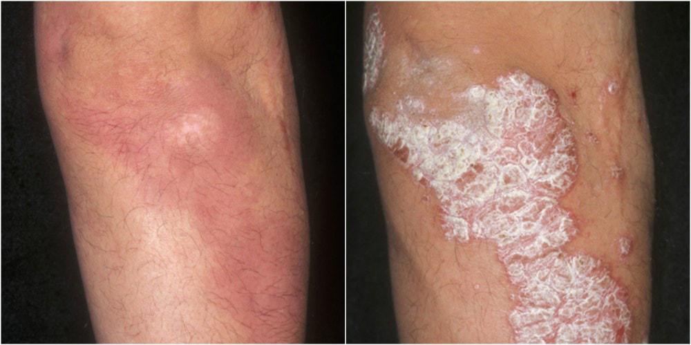 Psoriasis | Pine Belt Dermatology