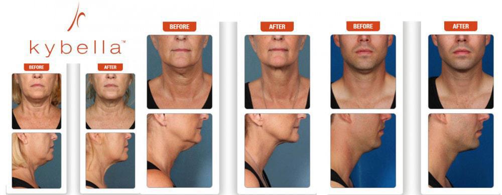 Kybella | Pine Belt Dermatology
