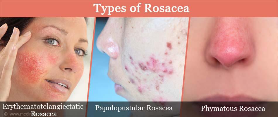 Rosacea | Pine Belt Dermatology