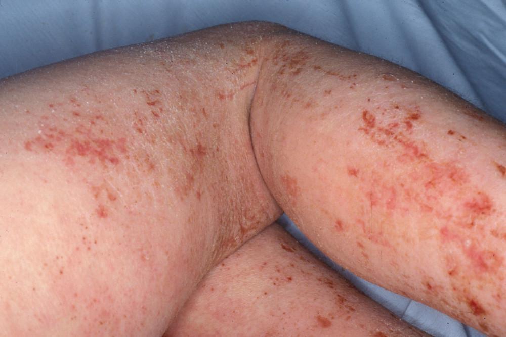 Rashes on arm | Pine Belt Dermatology