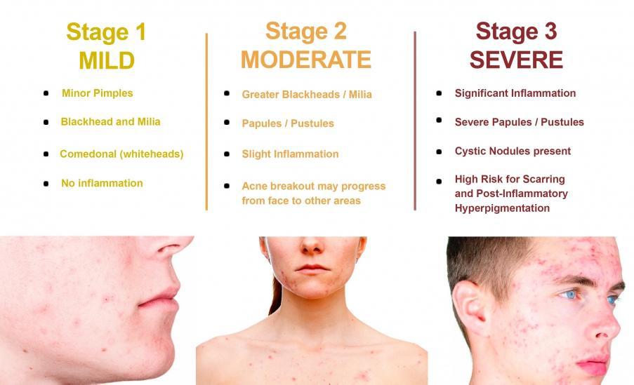 Acne Treatment Available | Pine Belt Dermatology