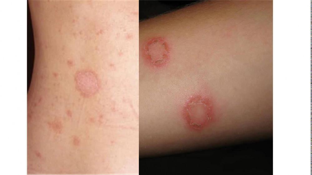 Fungal Infections of the Skin | Pine Belt Dermatology 