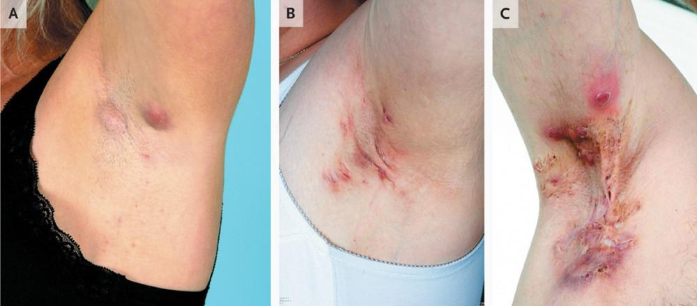 Hidradenitis | Pine Belt Dermatology
