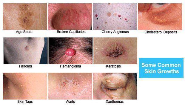 Common Skin Growths | Pine Belt Dermatology