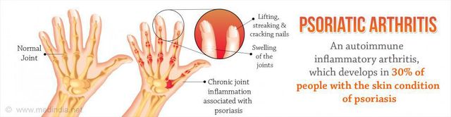 Psoriasis and Psoriatic Arthritis Can Occur Together