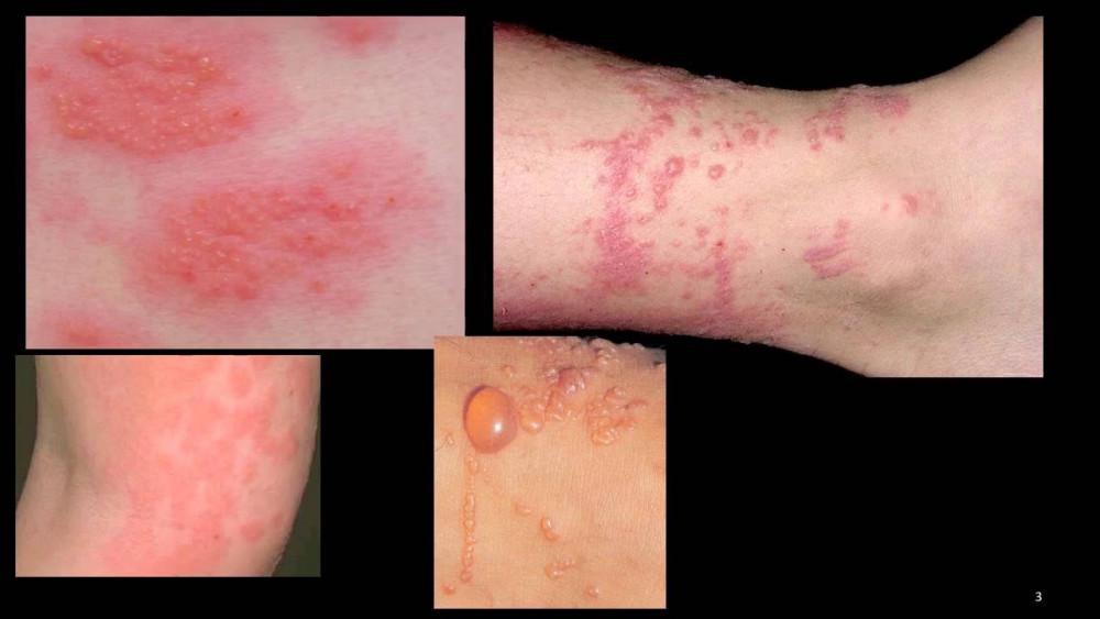 Dermatitis | Pine Belt Dermatology