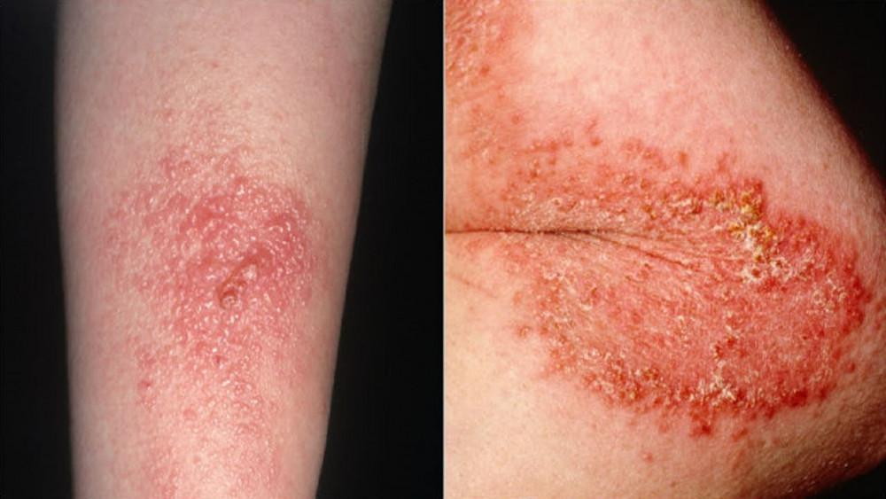 Poison Ivy & Treatments | Pine Belt Dermatology