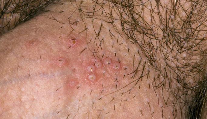 Genital Herpes Treatment | Pine Belt Dermatology