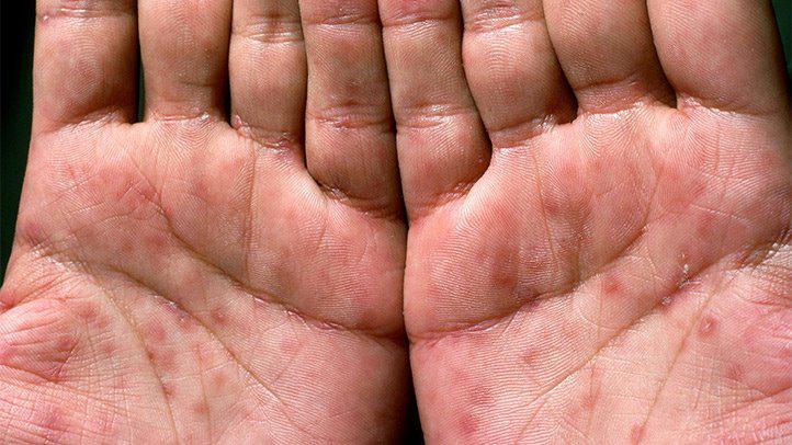 Syphilis | Pine Belt Dermatology