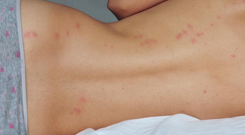 Things that bite in the night | Pine Belt Dermatology