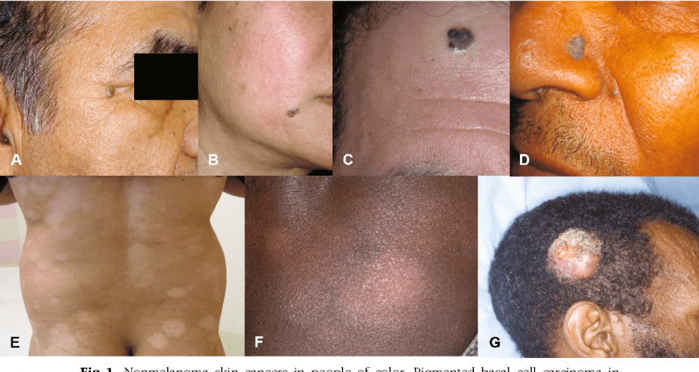 Skin Cancer in Patients of Color | Pine Belt Dermatology