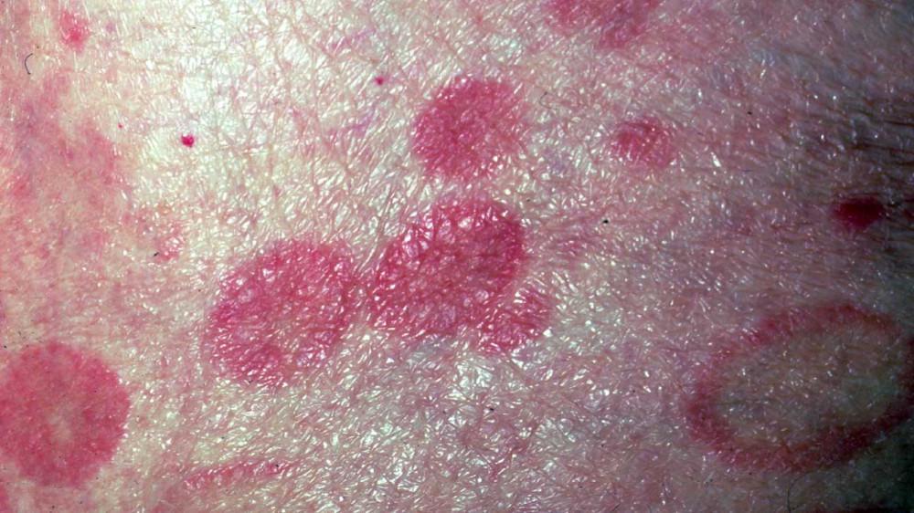 What is Cutaneous T-Cell Lymphoma | Pine Belt Dermatology