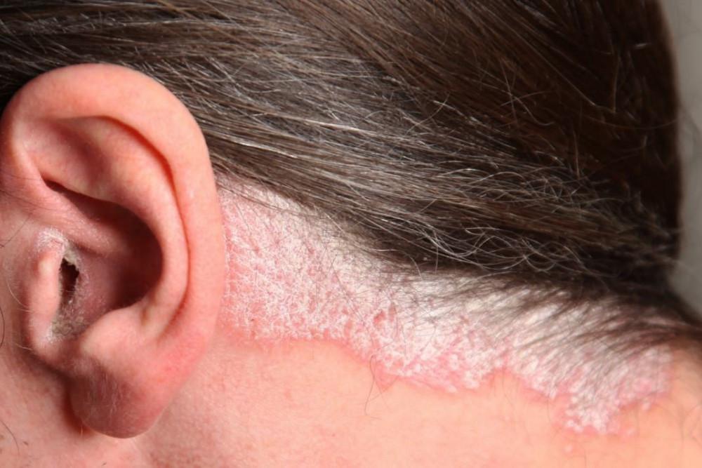 Scalp Psoriasis | Pine Belt Dermatology