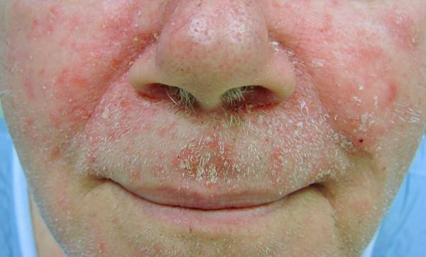 Seborrheic Dermatitis | Pine Belt Dermatology