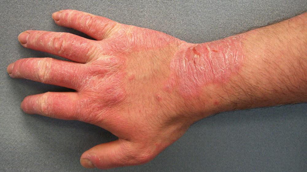 Hand Rashes | Pine Belt Dermatology