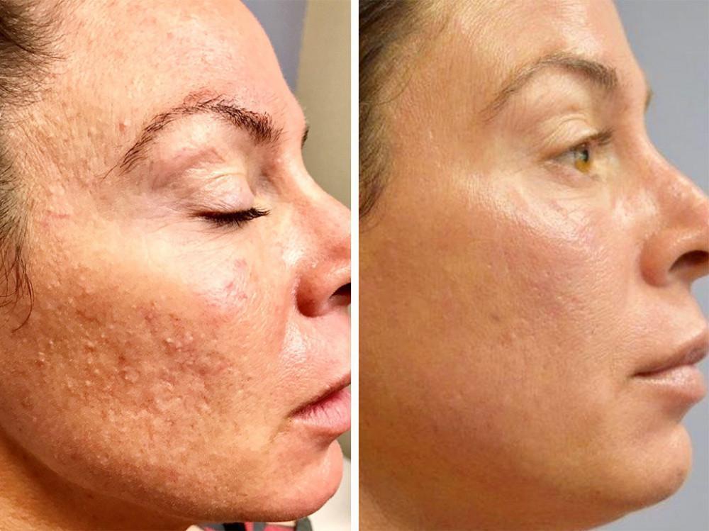 Strata Pen | Pine Belt Dermatology