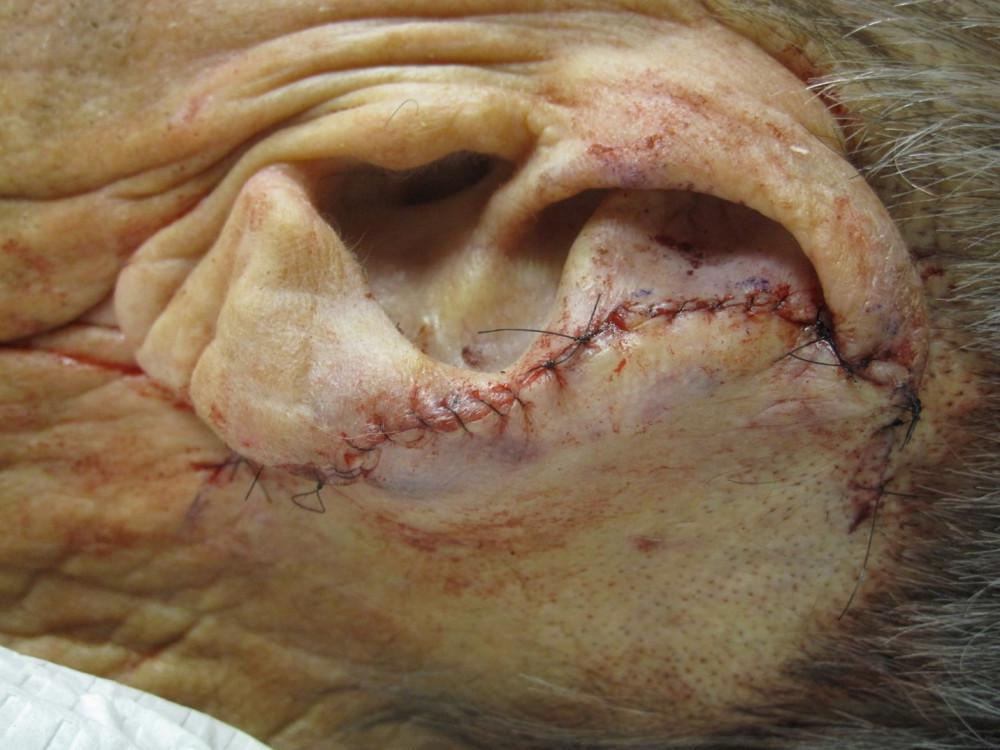 Before & After | Mohs Surgery | Pine Belt Dermatology