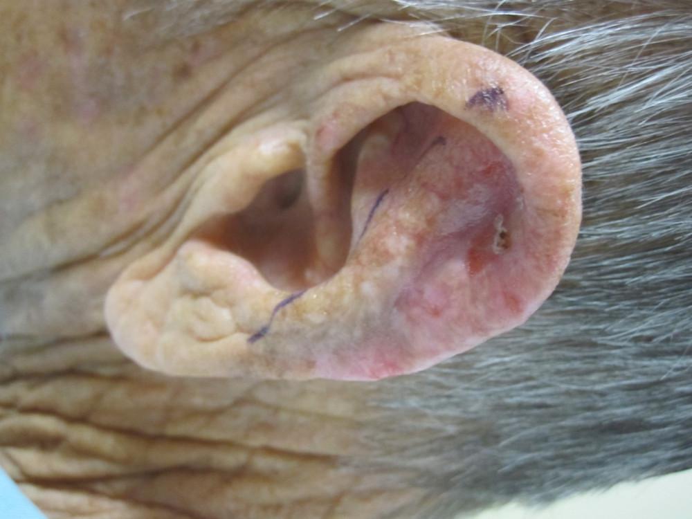 A close up of a person 's ear with a hole in it | Pine Belt Dermatology