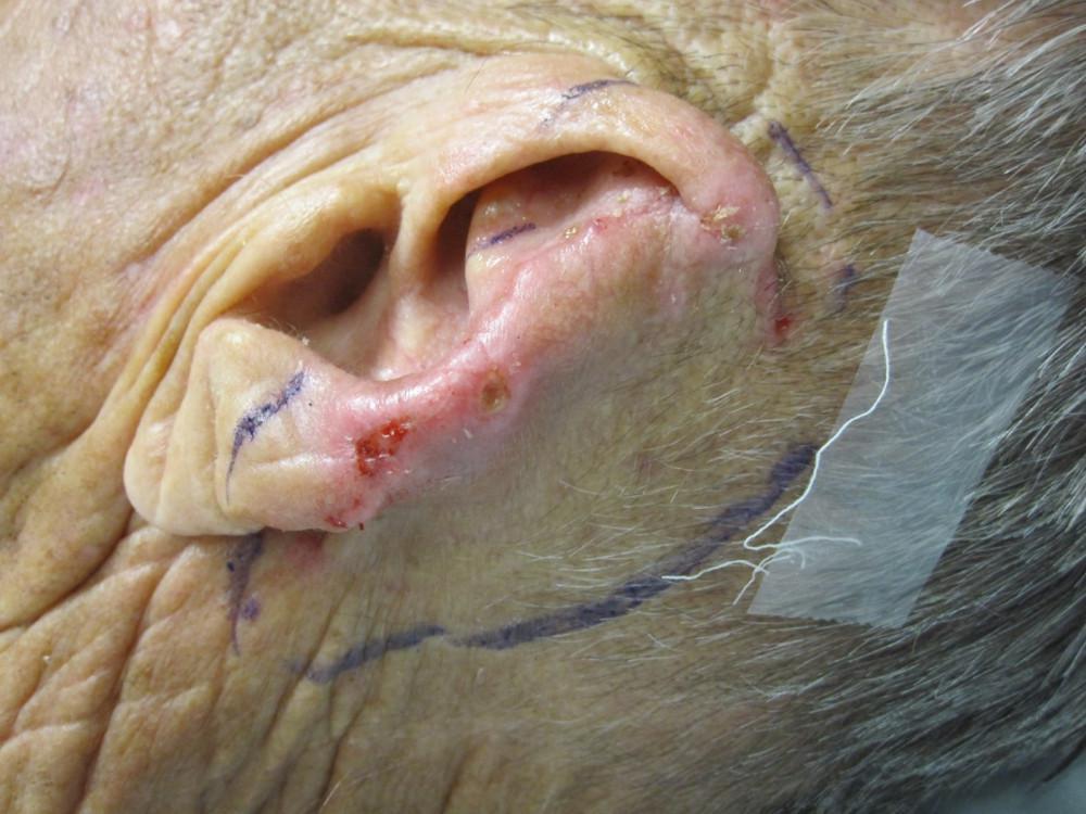 Mohs Surgery After Image | Pine Belt Dermatology