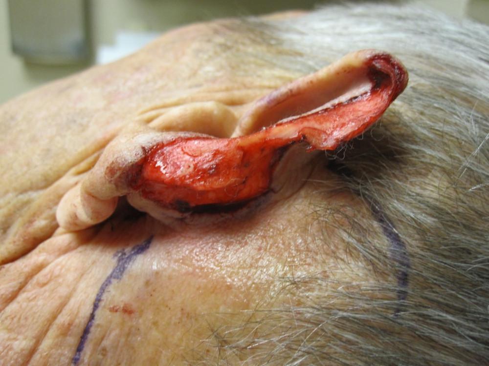 During Mohs Surgery | Pine Belt Dermatology