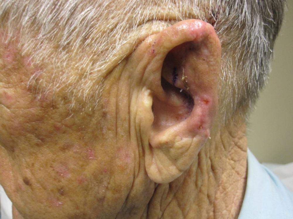 A close up of an elderly man 's ear with a hole in it. | Pine Belt Dermatology