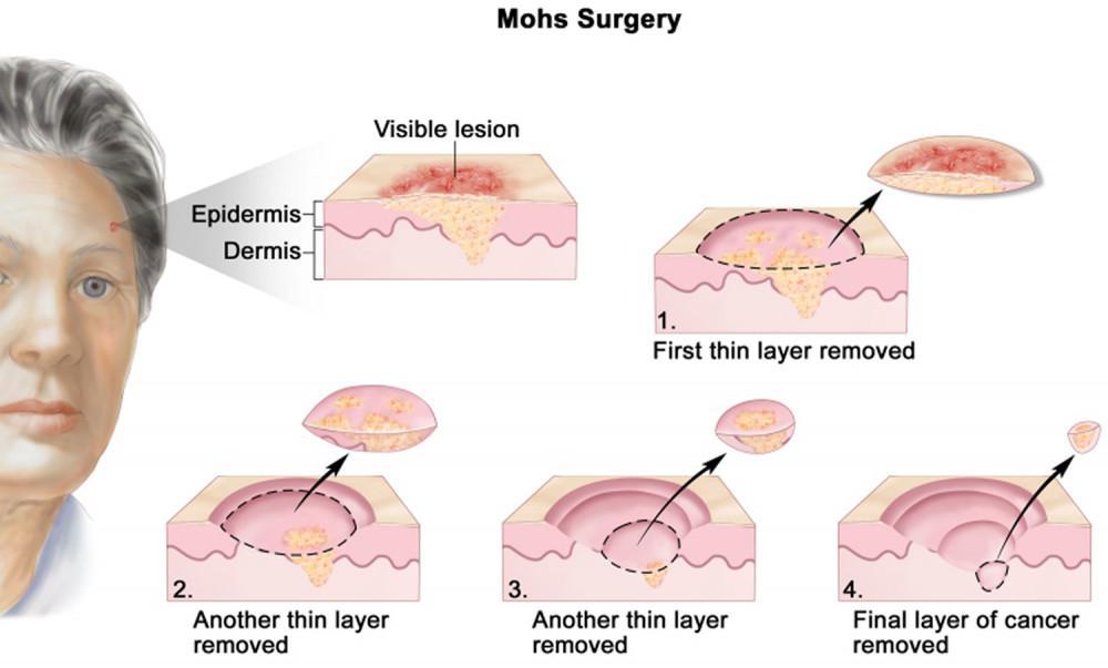 Mohs Case Before & After | Pine Belt Dermatology