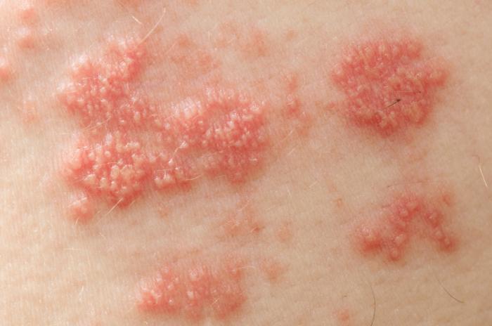 Shingles | Pine Belt Dermatology