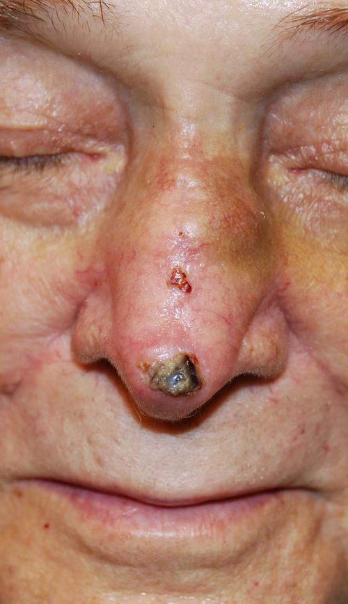 Nose | Pine Belt Dermatology