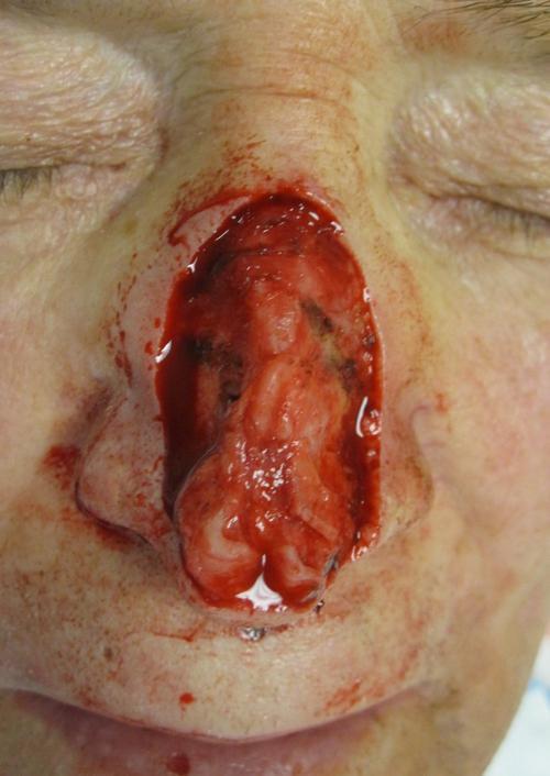 March Mohs Case Presentation | Pine Belt Dermatology