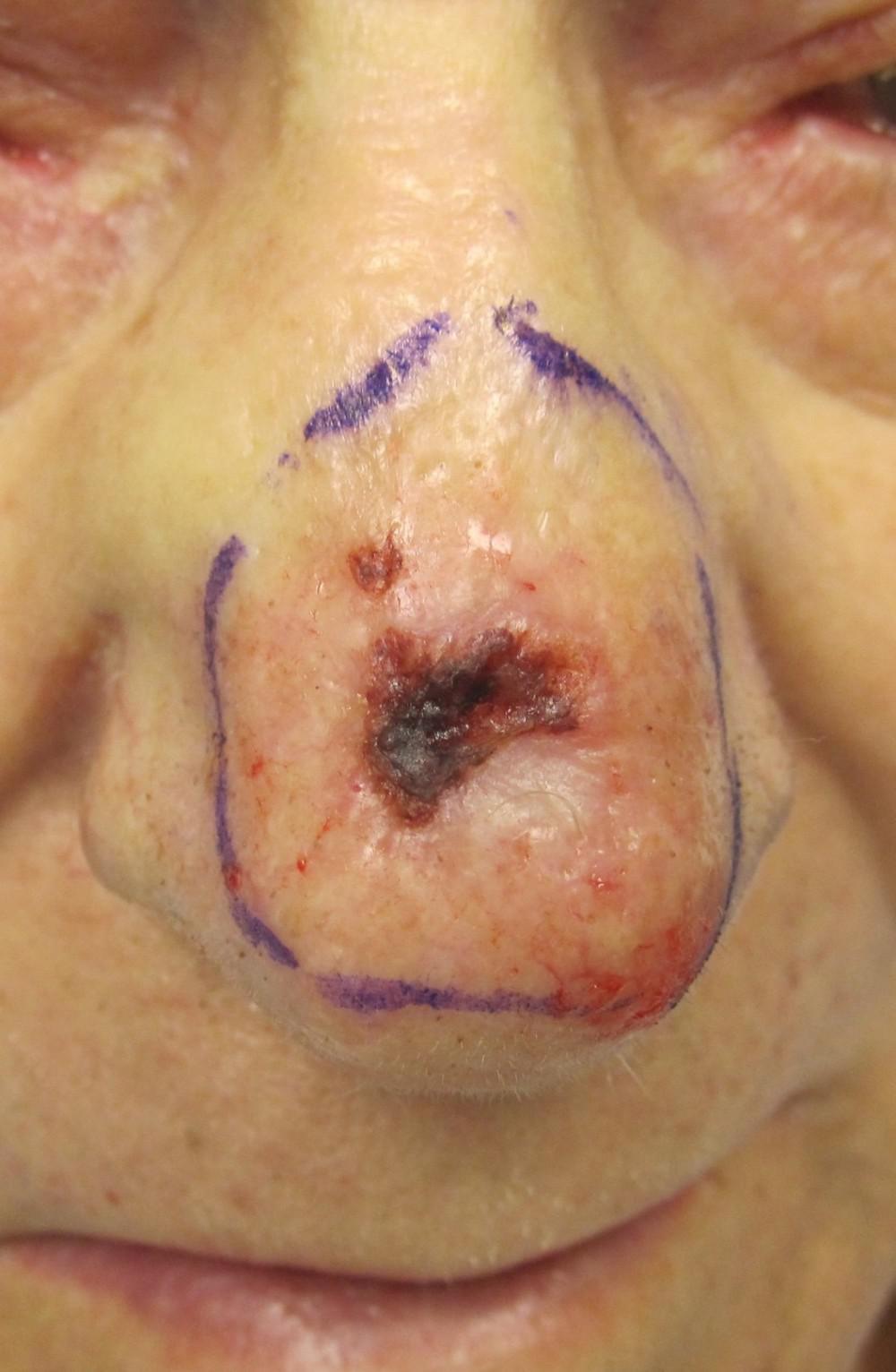 Mohs | Pine Belt Dermatology