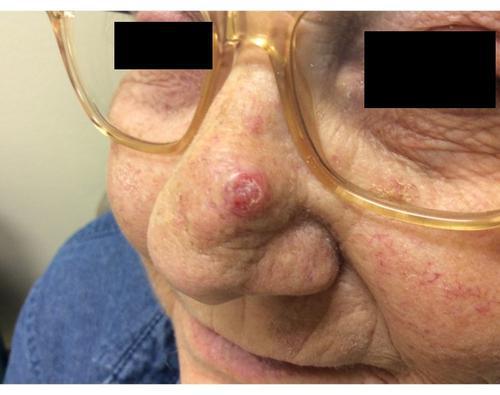 April Mohs Case Presentation | Pine Belt Dermatology