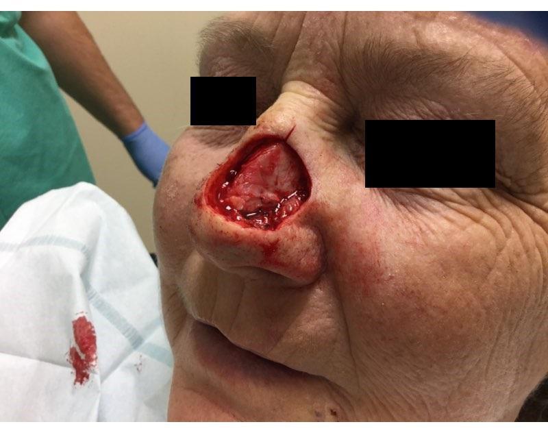 Cystic Basal | Pine Belt Dermatology