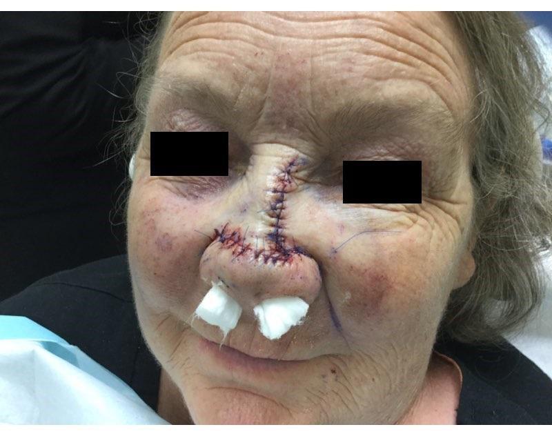 April Mohs Case Prevention - Cystic Basal | Pine Belt Dermatology