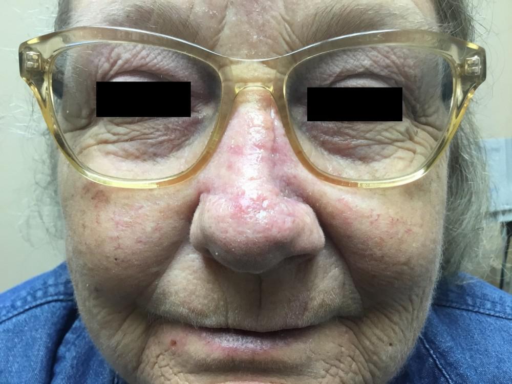Case Presentation | Cystic Basal | Pine Belt Dermatology