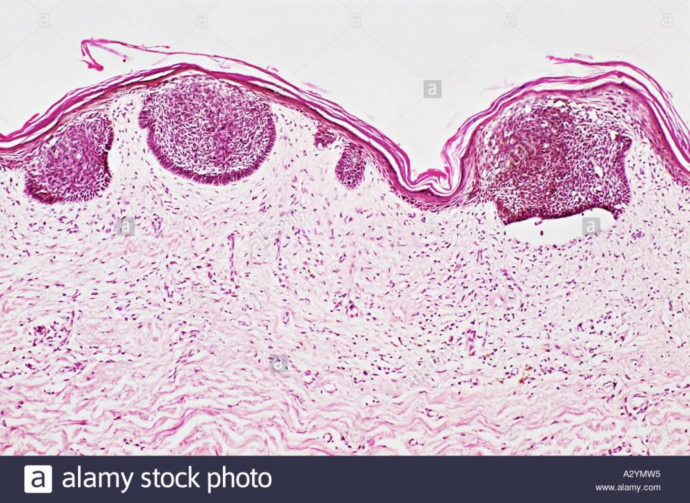 April Mohs Case Prevention | Pine Belt Dermatology