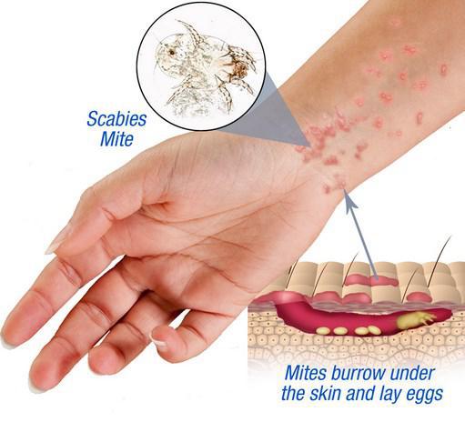 The itch of scabs | Pine Belt Dermatology