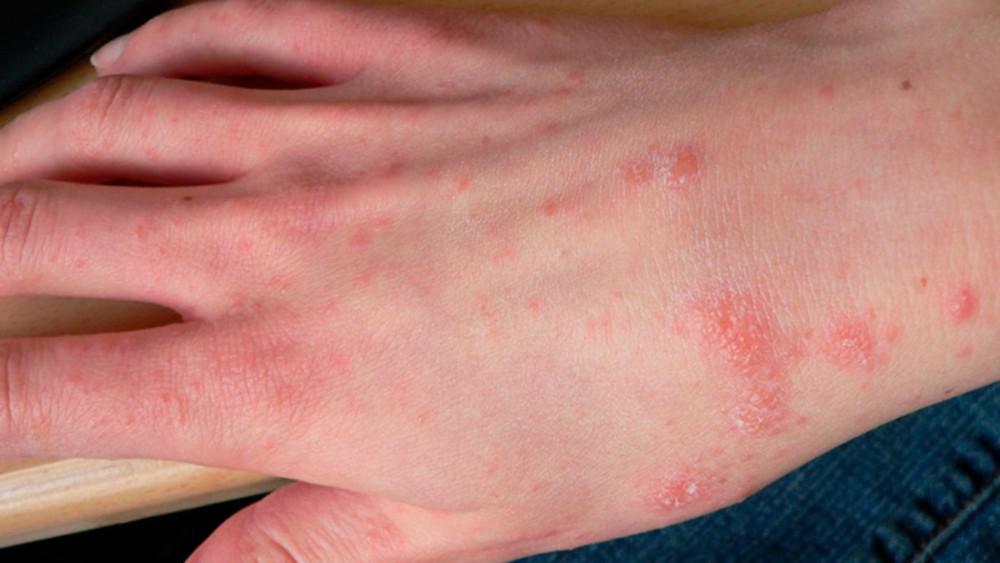 Scabs | Pine Belt Dermatology