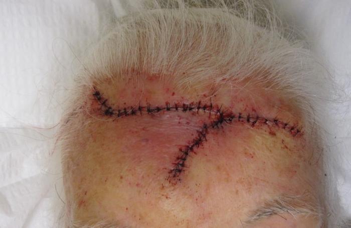 Mohs Case For May: Excision on the Scalp | Pine Belt Dermatology