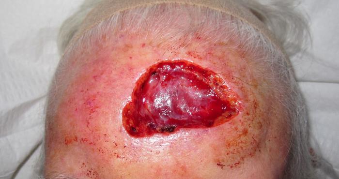 Excision on the Scalp before treatment | Pine Belt Dermatology