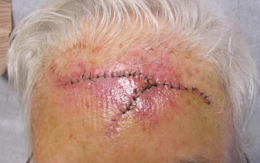 Mohs Case | Excision on the Scalp | Pine Belt Dermatology