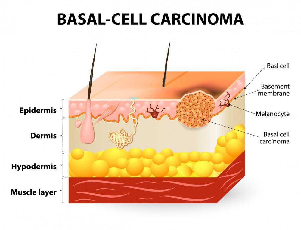 Mohs Case For May | Pine Belt Dermatology