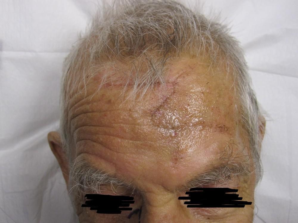 Squamous Cell Carcinomas After Treatment | Pine Belt Dermatology