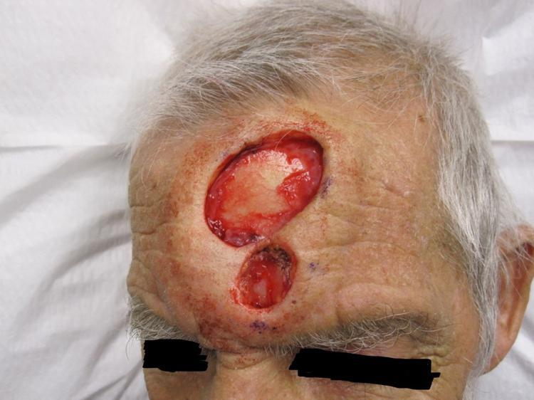 Squamous Cell Carcinomas Treatment | Pine Belt Dermatology