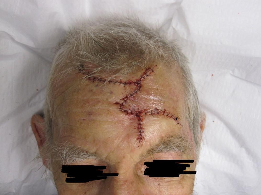 Squamous Cell Carcinomas on Forehead | Pine Belt Dermatology