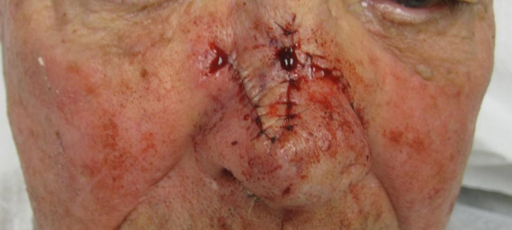 Basal Cell Carcinoma | Mohs | Pine Belt Dermatology