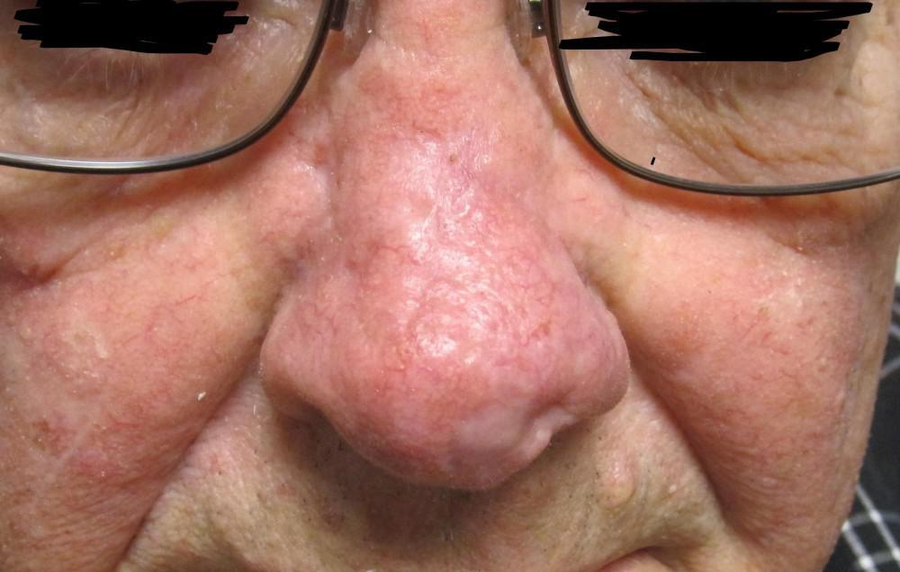 A close up of a person 's face with glasses and a healed nose | Pine Belt Dermatology